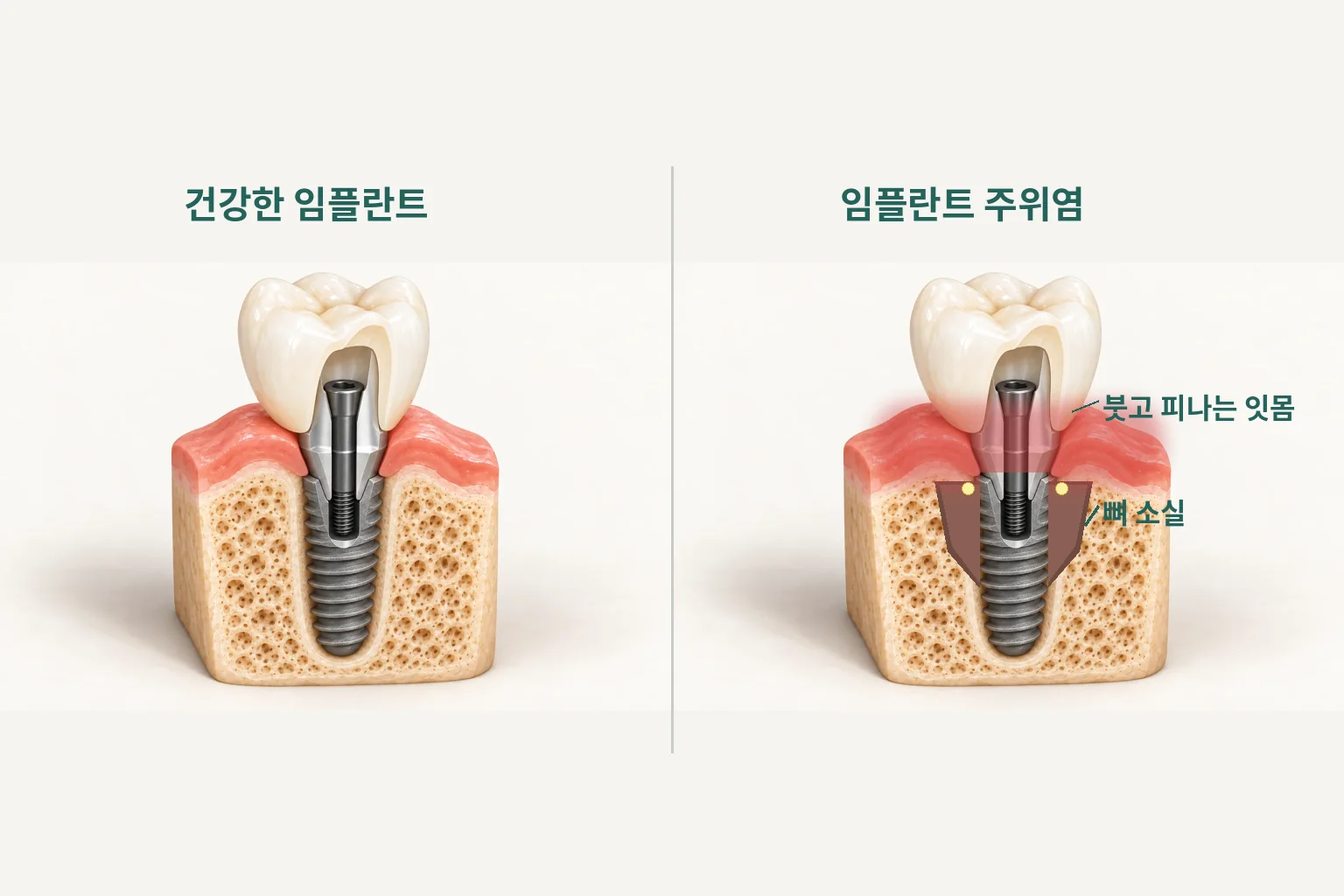 건강한 임플란트와 뼈가 녹은 임플란트 주위염의 비교 그림
